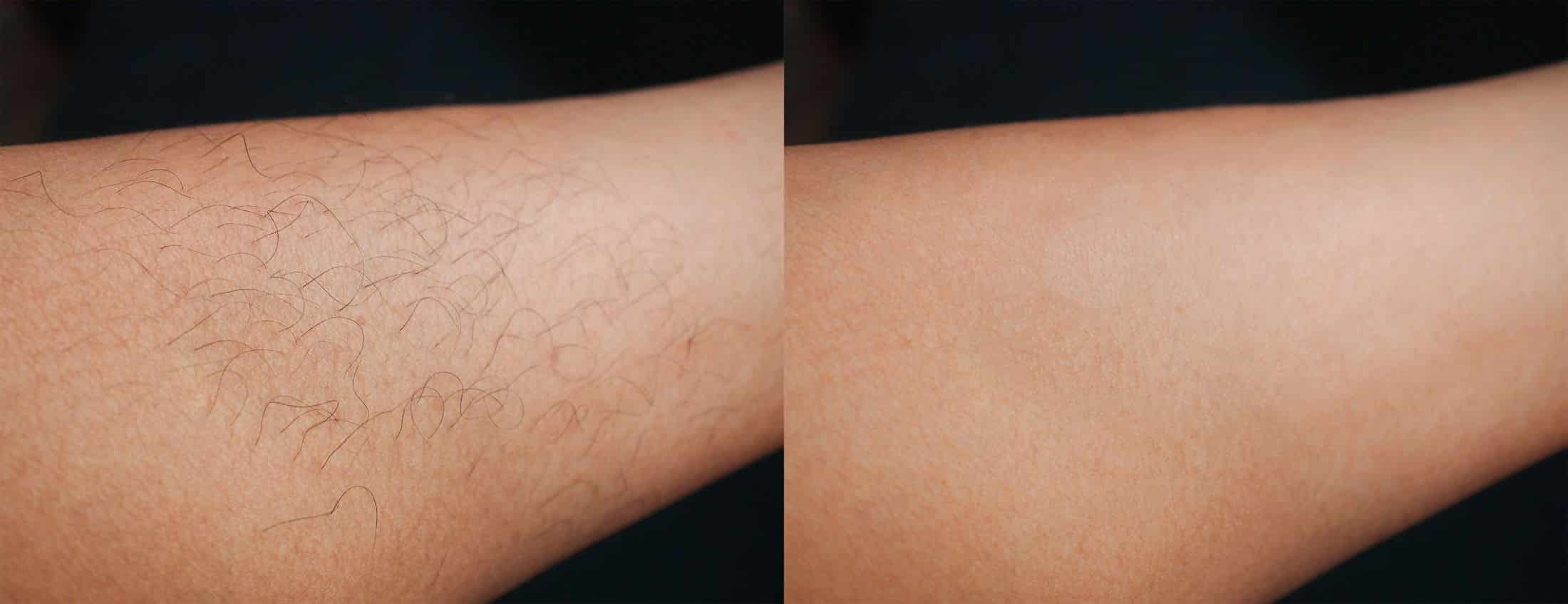 Youthful Spirit Aesthetics Laser Hair Removal